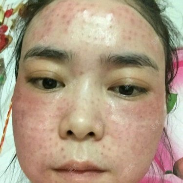 我头天晚上打完水光针后满脸小包第二天满脸红肿胀痛痒小包也没有消