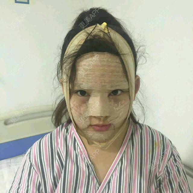 更美 - 天上宝宝的经验 | 深圳 | 假体鼻子下巴