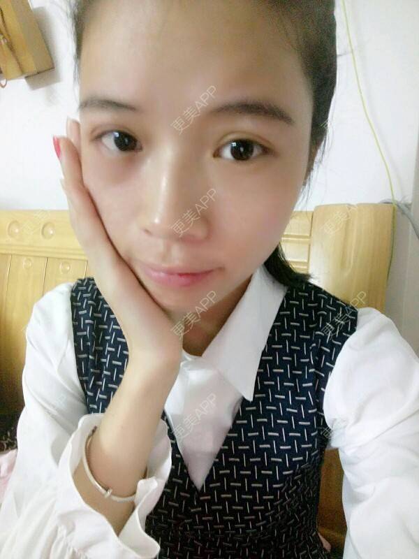 更美 - 心疼妳的心疼。的自体脂肪全面部填充经验 | 热溶脂祛眼袋 | 美购日记 | 自体脂肪全面部填充 | 广州