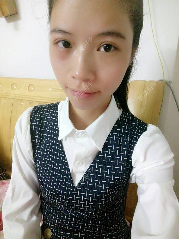 更美 - 心疼妳的心疼。的自体脂肪全面部填充经验 | 热溶脂祛眼袋 | 美购日记 | 自体脂肪全面部填充 | 广州