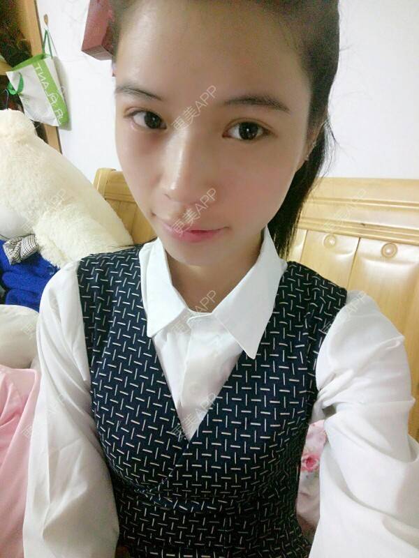 更美 - 心疼妳的心疼。的自体脂肪全面部填充经验 | 热溶脂祛眼袋 | 美购日记 | 自体脂肪全面部填充 | 广州