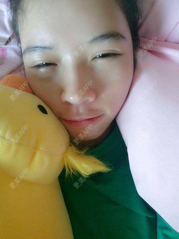 更美 - 心疼妳的心疼。的自体脂肪全面部填充经验 | 热溶脂祛眼袋 | 美购日记 | 自体脂肪全面部填充 | 广州