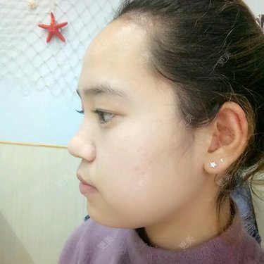 额头太高加上太阳穴部位有些凹陷显得人特别老山根低加上鼻头有些大