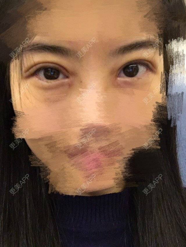 更美 - 更美用户xkRcLM3DQQ的经验 | 开眼角修复 | 珠海