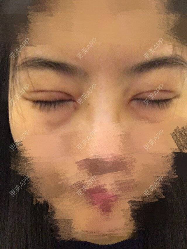 更美 - 更美用户xkRcLM3DQQ的经验 | 开眼角修复 | 珠海