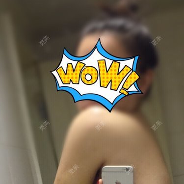 整容专用小马甲