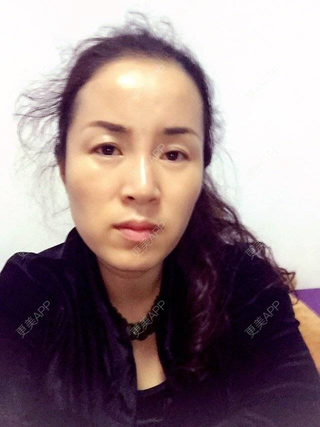 更美 - 更美用户XH6KO2jkkb的经验 | 自体脂肪面部年轻化 | 银川