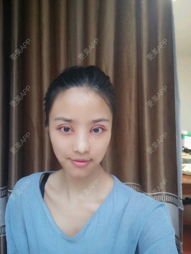 更美 - 我有一霜大眼睛的双眼皮经验 | 韩式无痕双眼皮 | 美基元 | 定点双眼皮 | 武汉