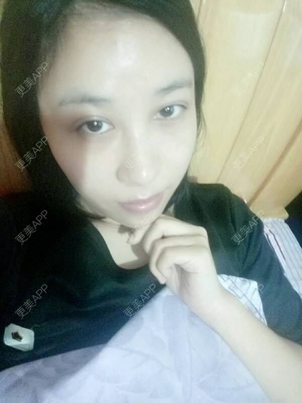 更美 - 更美用户Rgf5OmHSOo的自体脂肪全面部填充经验 | 美购日记 | 自体脂肪全面部填充 | 武汉
