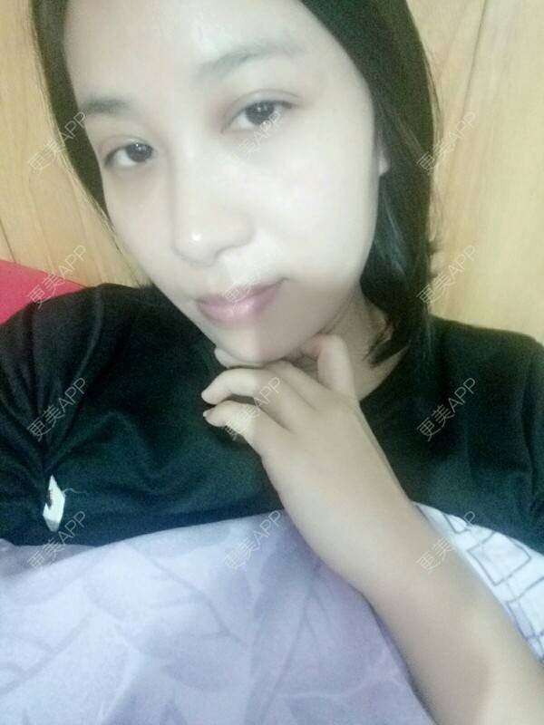 更美 - 更美用户Rgf5OmHSOo的自体脂肪全面部填充经验 | 美购日记 | 自体脂肪全面部填充 | 武汉