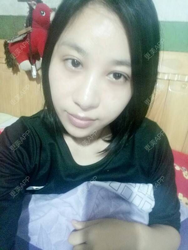 更美 - 更美用户Rgf5OmHSOo的自体脂肪全面部填充经验 | 美购日记 | 自体脂肪全面部填充 | 武汉