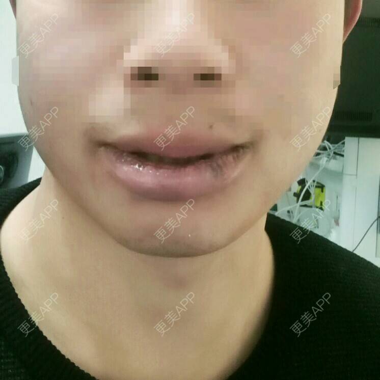 更美 - 更美800的M唇成形经验 | M唇成形 | 下厚唇改薄 | 美购日记 | 北京