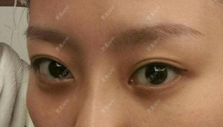 更美 - 兔小妖要更美的经验 | 眼部整形 | 热溶脂祛眼袋 | 内路祛眼袋 | 广州