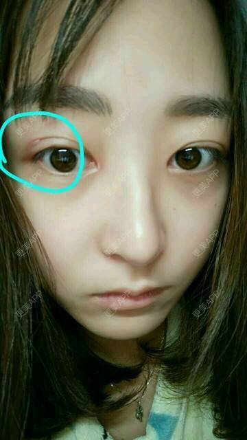 更美 - 兔子君儿的经验 | 埋线双眼皮术后 | 合肥