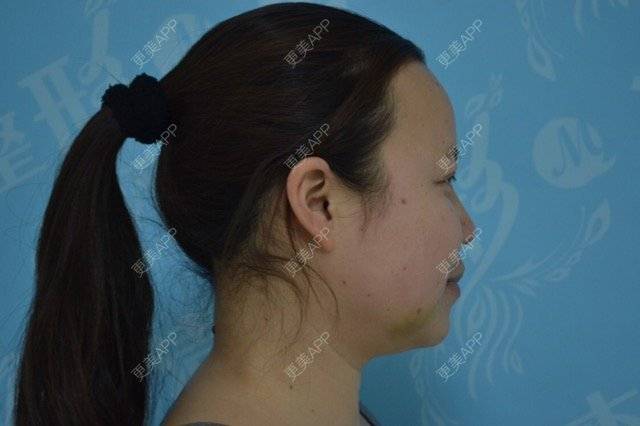 更美 - 小小眉的全切双眼皮经验 | 去颊脂垫 | 大同 | 全切双眼皮 | 除皱瘦脸