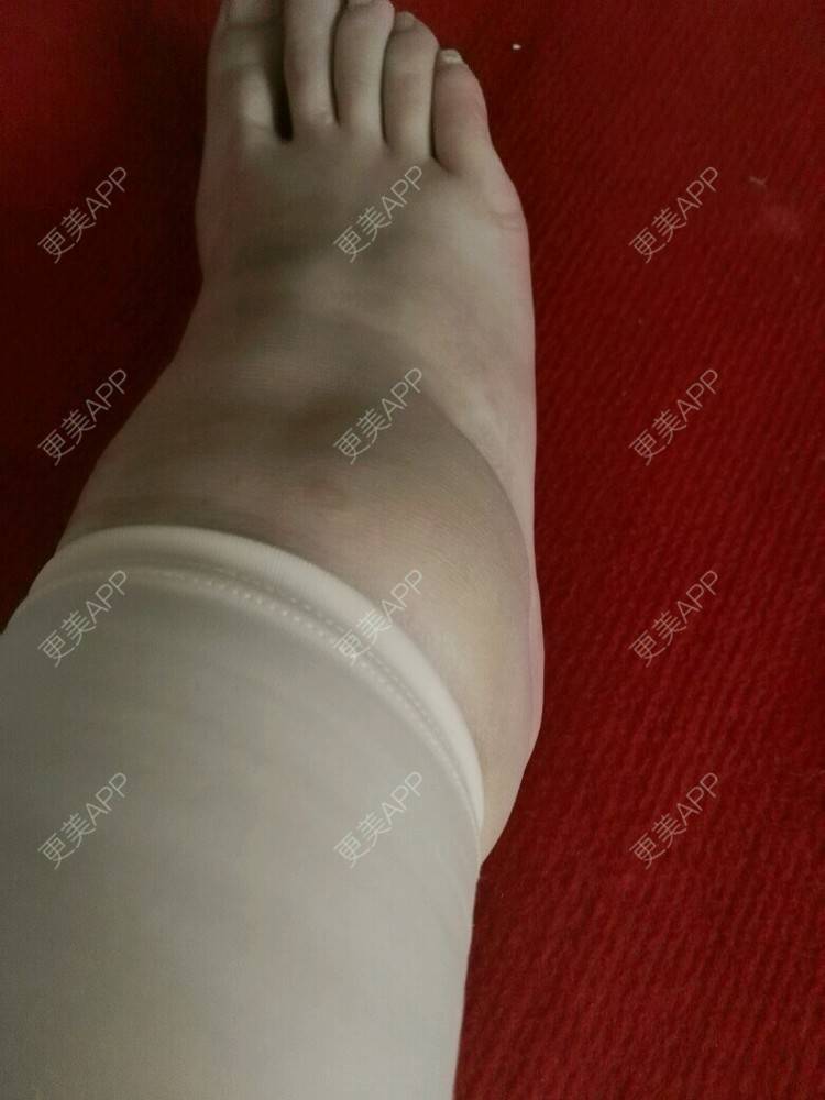 更美 - 我要变成铅笔腿的经验 | 美购日记 | 抽脂瘦腿 | 抽脂大小腿 | 郑州