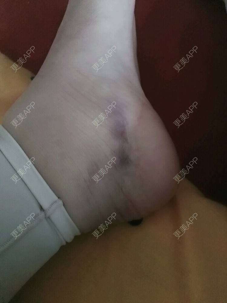 更美 - 我要变成铅笔腿的经验 | 美购日记 | 抽脂瘦腿 | 抽脂大小腿 | 郑州