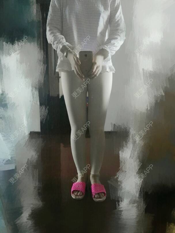 更美 - 我要变成铅笔腿的经验 | 美购日记 | 抽脂瘦腿 | 抽脂大小腿 | 郑州