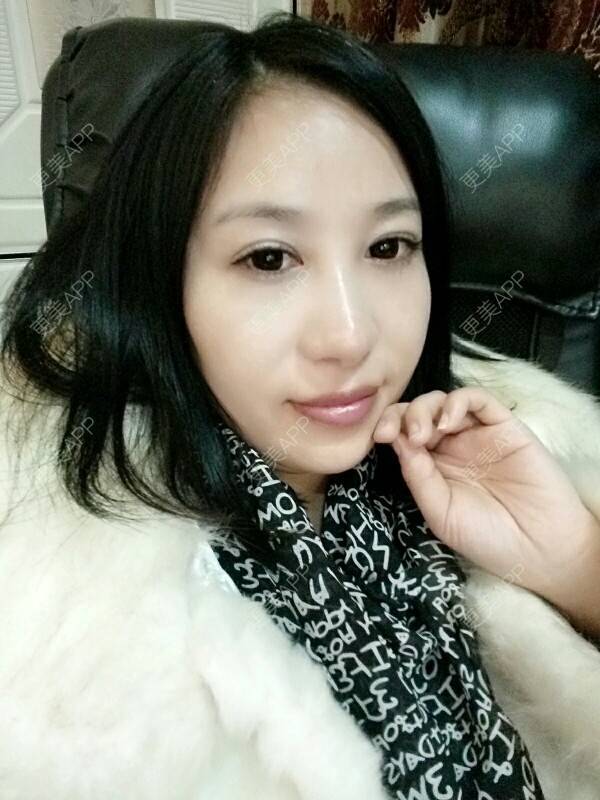 更美 - 更美用户Rgf5OmHSOo的自体脂肪全面部填充经验 | 美购日记 | 自体脂肪全面部填充 | 武汉