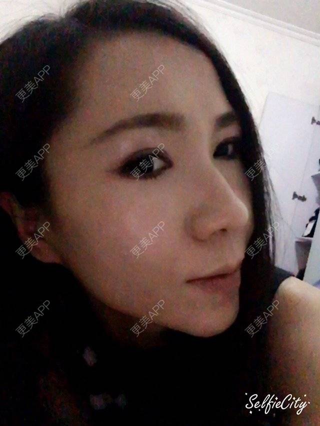 更美 - 瞳兔兔的经验 | 人中缩短 | 乌鲁木齐