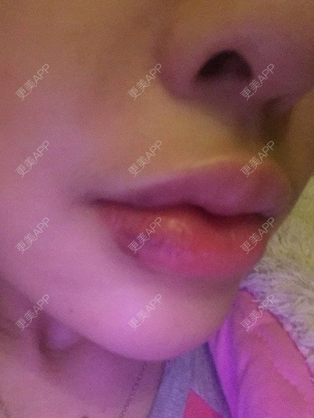更美 - 18*******96的经验 | 玻尿酸 | 玻尿酸唇部