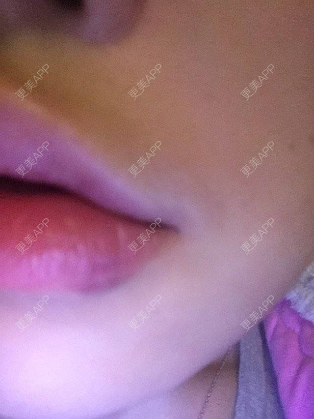 更美 - 18*******96的经验 | 玻尿酸 | 玻尿酸唇部