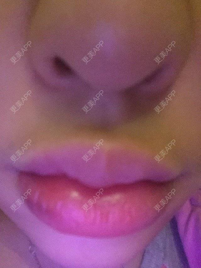更美 - 18*******96的经验 | 玻尿酸 | 玻尿酸唇部