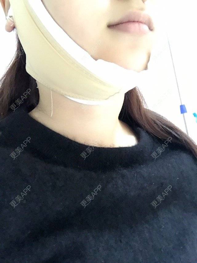 更美 - 大长腿欧尼的吸脂瘦脸经验 | 美购日记 | 吸脂瘦脸 | 双下巴吸脂 | 武汉