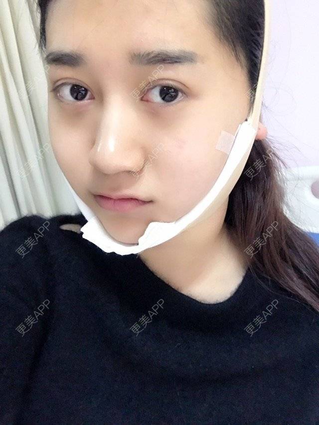 更美 - 大长腿欧尼的吸脂瘦脸经验 | 美购日记 | 吸脂瘦脸 | 双下巴吸脂 | 武汉