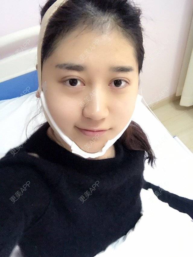 更美 - 大长腿欧尼的吸脂瘦脸经验 | 美购日记 | 吸脂瘦脸 | 双下巴吸脂 | 武汉