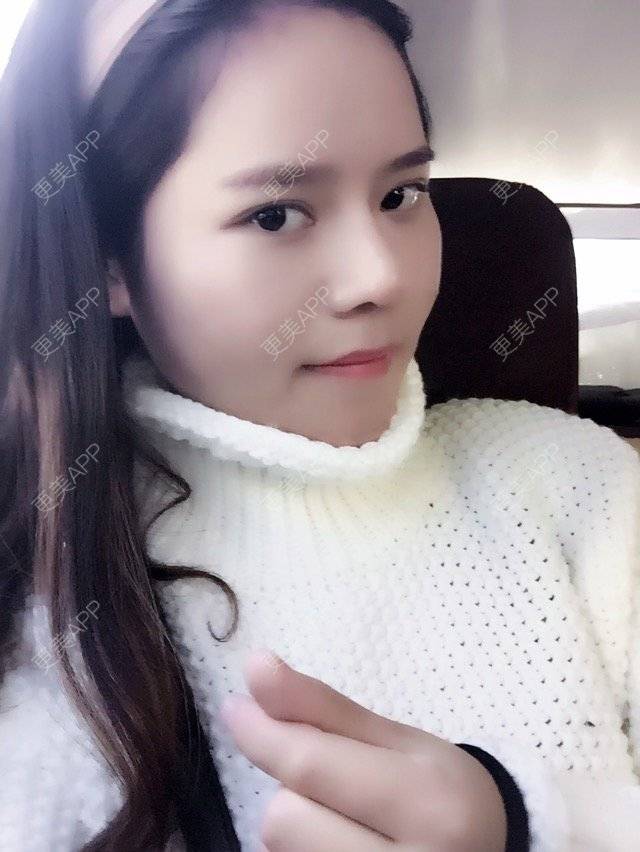 更美 - 大大饭baby的隆鼻经验 | 美购日记 | 鼻头鼻翼缩小 | 隆鼻 | 鼻部多项 | 鼻小柱延长 | 上海