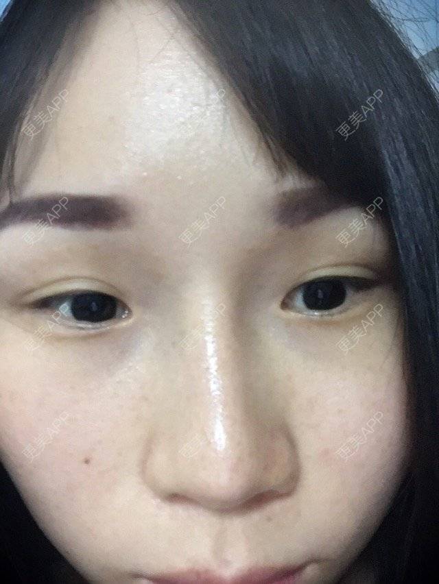 更美 - 失$败是成功之母的经验 | 眼睛双眼皮修复 | 埋线双眼皮修复 | 眼部整形 | 深圳