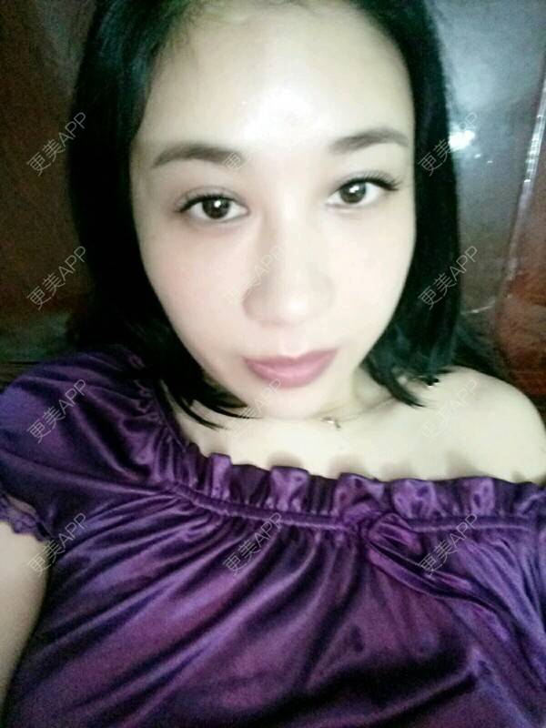 更美 - 更美用户Rgf5OmHSOo的自体脂肪全面部填充经验 | 美购日记 | 自体脂肪全面部填充 | 武汉