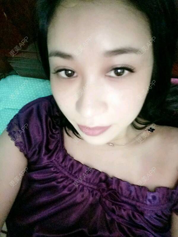 更美 - 更美用户Rgf5OmHSOo的自体脂肪全面部填充经验 | 美购日记 | 自体脂肪全面部填充 | 武汉