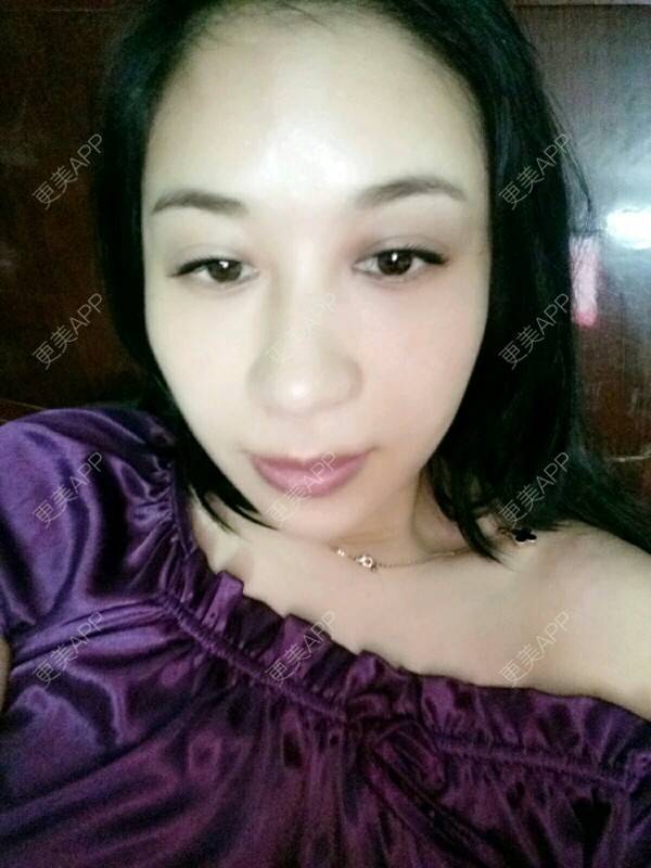 更美 - 更美用户Rgf5OmHSOo的自体脂肪全面部填充经验 | 美购日记 | 自体脂肪全面部填充 | 武汉