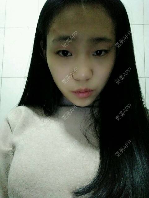 更美 - 星宝宝的经验 | 割双眼皮 | 伊春