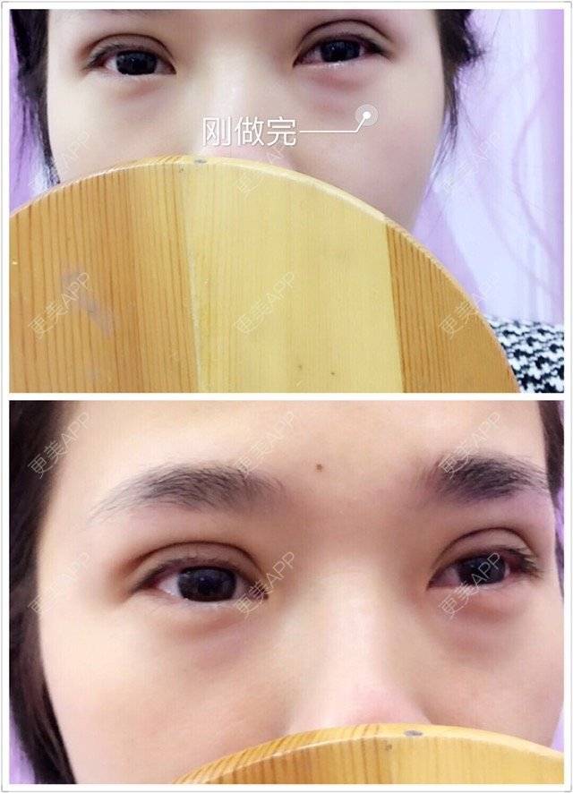 更美 - 「Keep」Sth.的定点双眼皮经验 | 厦门 | 定点双眼皮