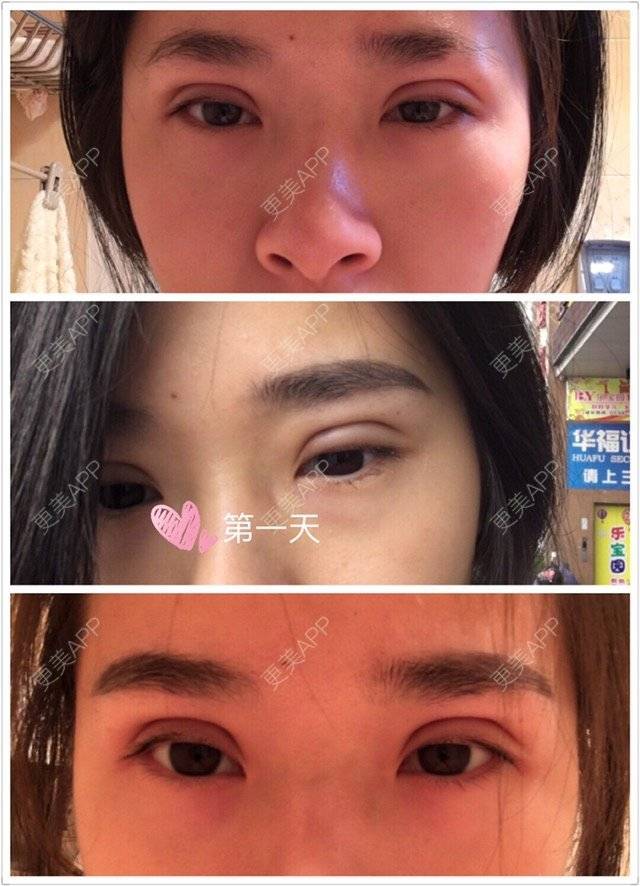 更美 - 「Keep」Sth.的定点双眼皮经验 | 厦门 | 定点双眼皮