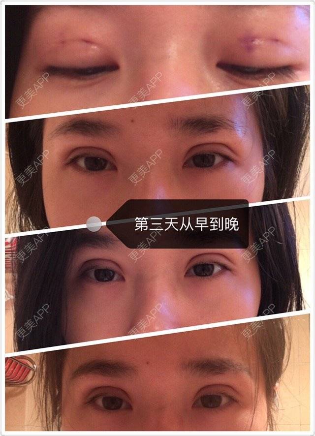 更美 - 「Keep」Sth.的定点双眼皮经验 | 厦门 | 定点双眼皮