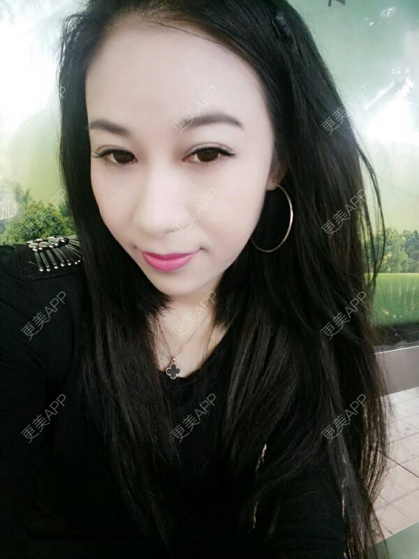 更美 - 更美用户Rgf5OmHSOo的自体脂肪全面部填充经验 | 美购日记 | 自体脂肪全面部填充 | 武汉
