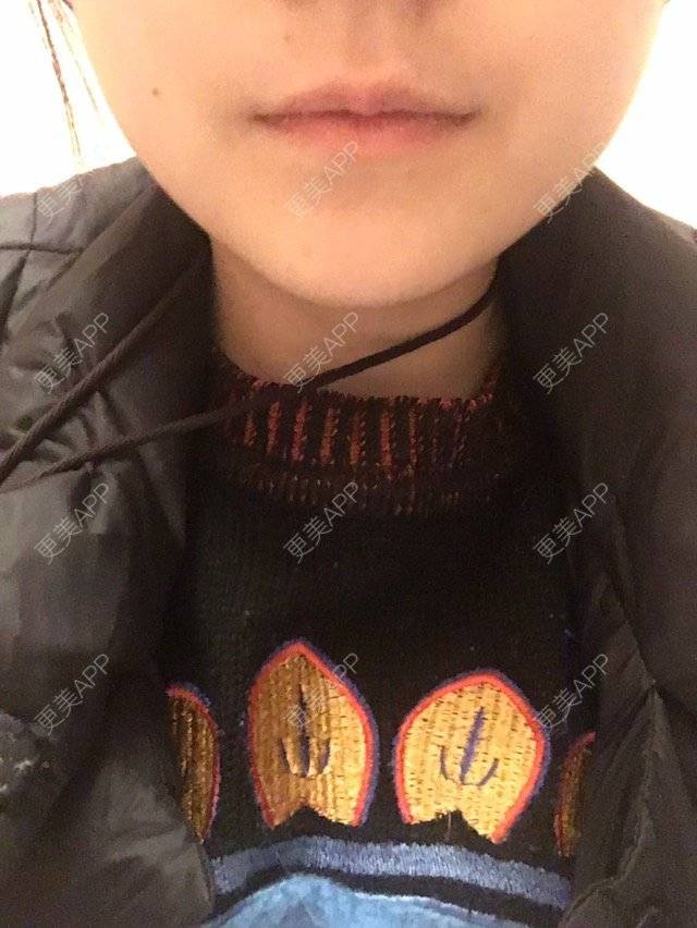 更美 - 大CC👑的经验 | 自体脂肪丰唇 | 成都