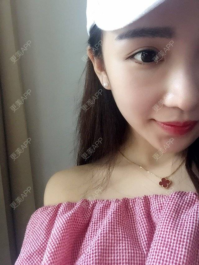 更美 - 布鲁格拉苏的经验 | 假体垫鼻基底