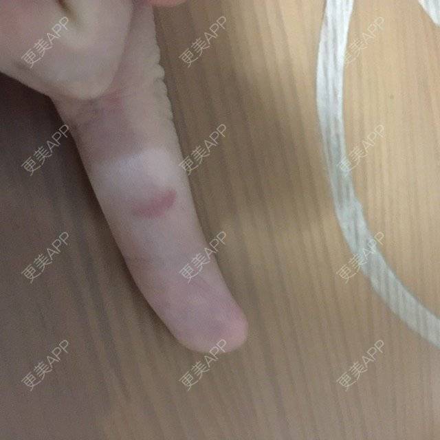 更美 - 更美用户5074551926的经验 | 缩鼻翼 | 鼻翼缩小