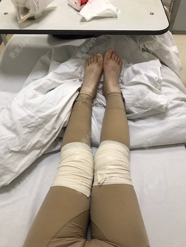 更美 - ʕ·ᴥ·ʔ的经验 | 大腿吸脂第一周 | 美购日记 | 吸脂瘦大腿1 | 小腿吸脂 | 上海