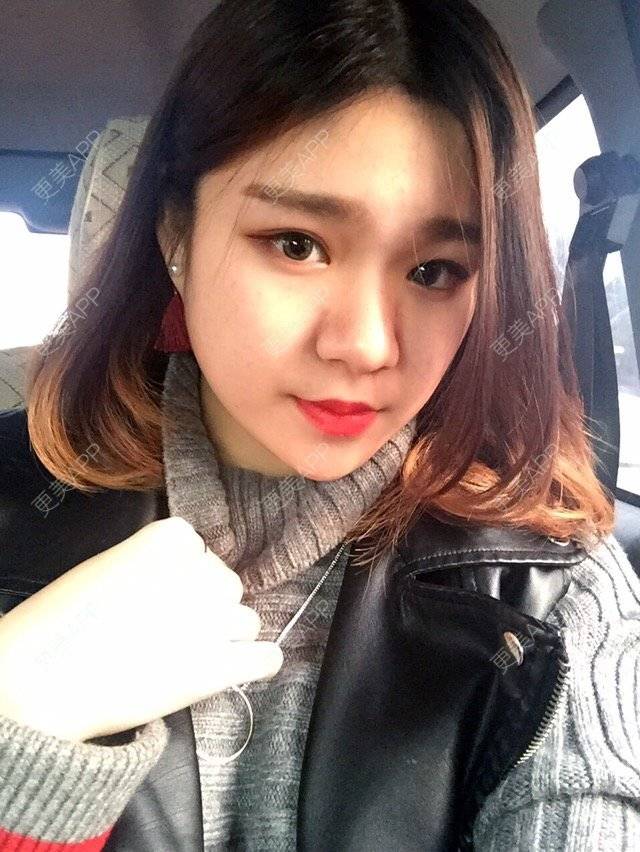 更美 - kikichan的吸脂瘦脸经验 | 美购日记 | 吸脂瘦脸 | 武汉