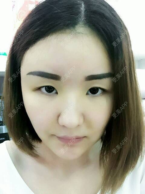 更美 - 李军 医生的自体脂肪全面部填充经验 | 美购日记 | 自体脂肪全面部填充 | 广州
