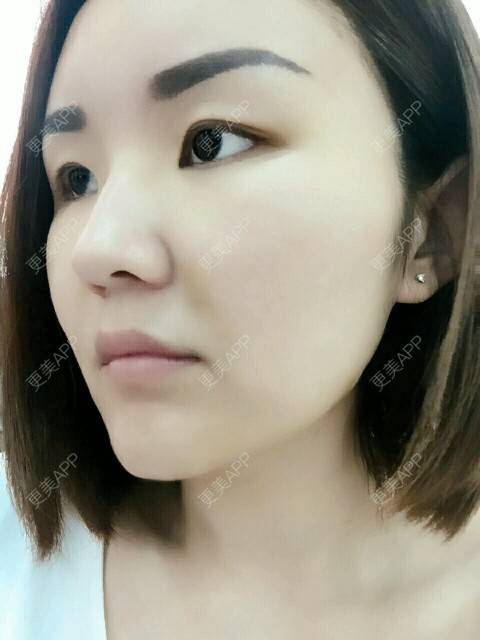 更美 - 李军 医生的自体脂肪全面部填充经验 | 美购日记 | 自体脂肪全面部填充 | 广州