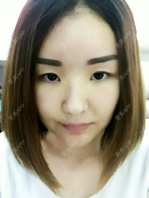 更美 - 李军 医生的自体脂肪全面部填充经验 | 美购日记 | 自体脂肪全面部填充 | 广州