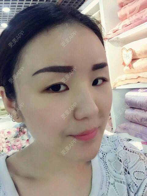更美 - 李军 医生的自体脂肪全面部填充经验 | 美购日记 | 自体脂肪全面部填充 | 广州
