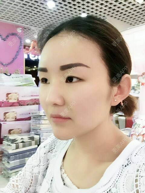 更美 - 李军 医生的自体脂肪全面部填充经验 | 美购日记 | 自体脂肪全面部填充 | 广州